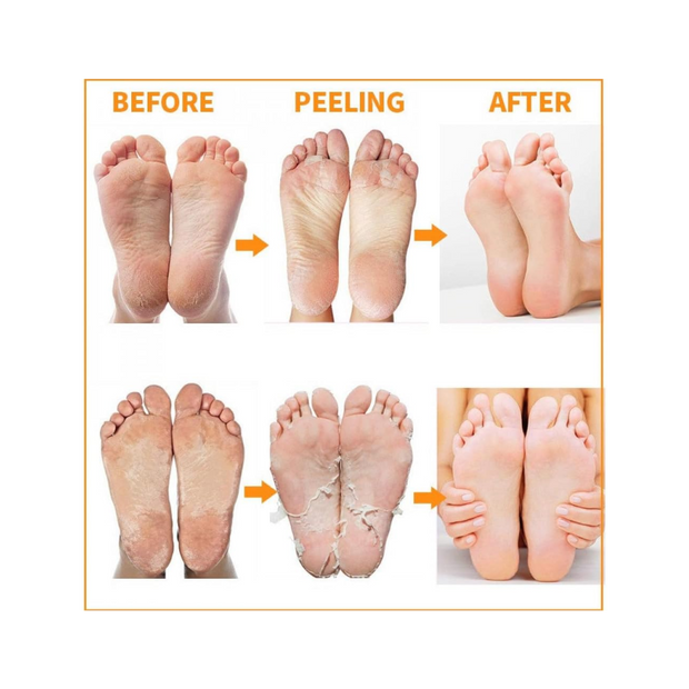 Exfoliating Magic Foot Socks – Callus Remover 1 Pair - Kodomo store